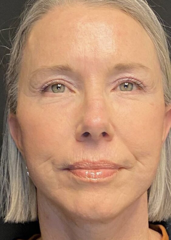 Deep Plane Facelift Before & After Image