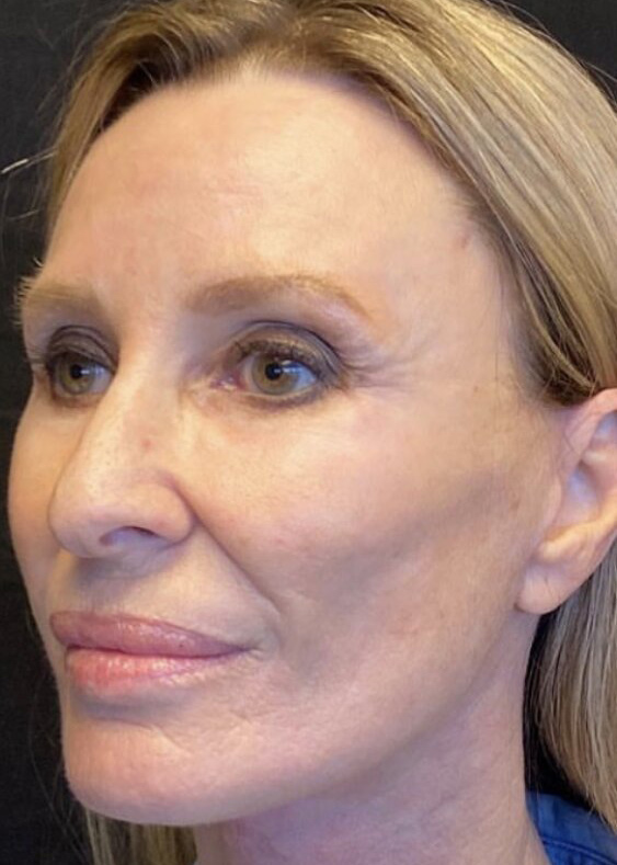 Deep Plane Facelift Before & After Image