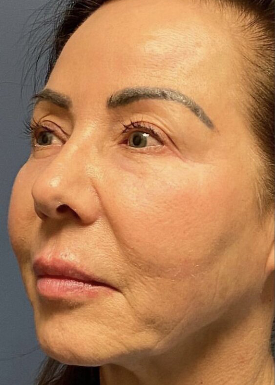 Deep Plane Facelift Before & After Image