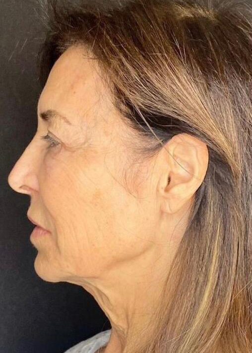 Deep Plane Facelift Before & After Image