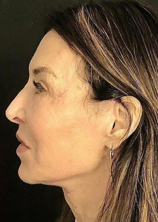 Deep Plane Facelift Before & After Image