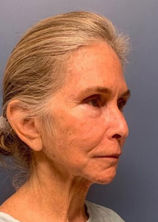 Deep Plane Facelift Before & After Image