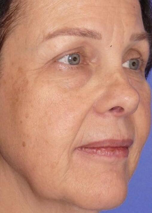 Deep Plane Facelift Before & After Image