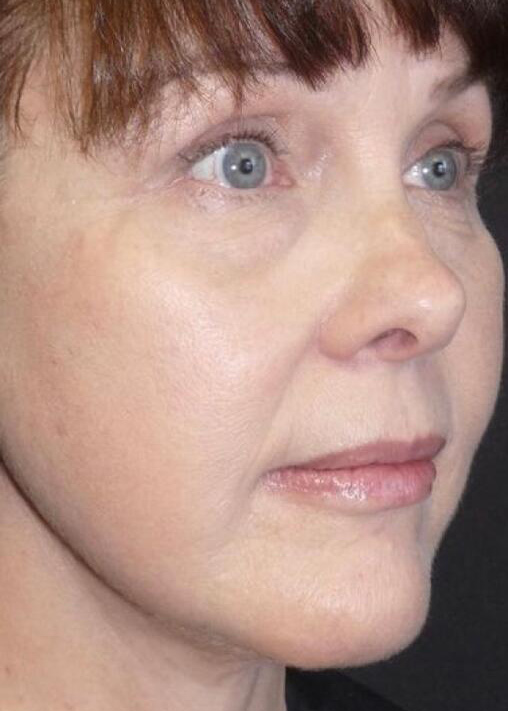 Deep Plane Facelift Before & After Image