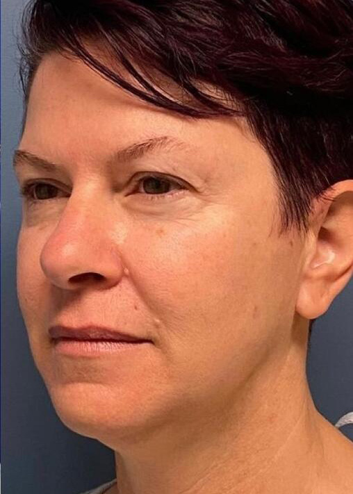 Deep Plane Facelift Before & After Image