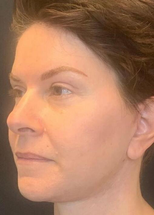 Deep Plane Facelift Before & After Image