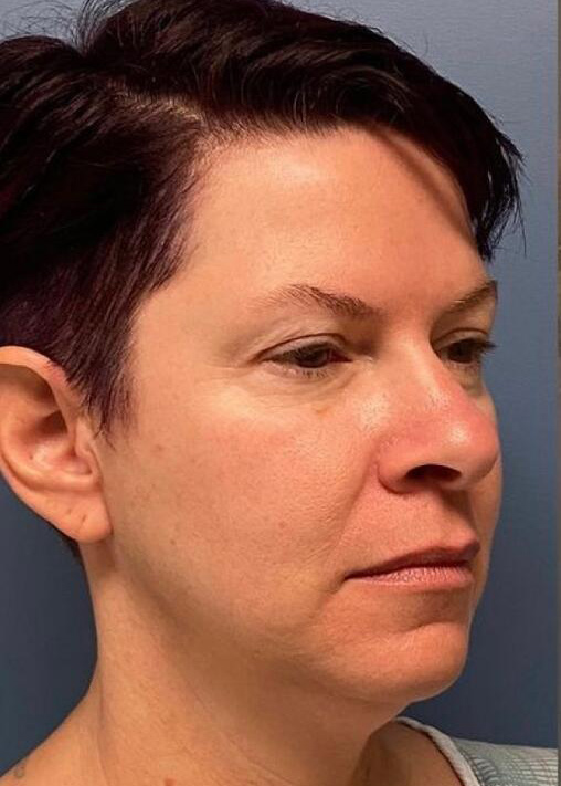 Deep Plane Facelift Before & After Image