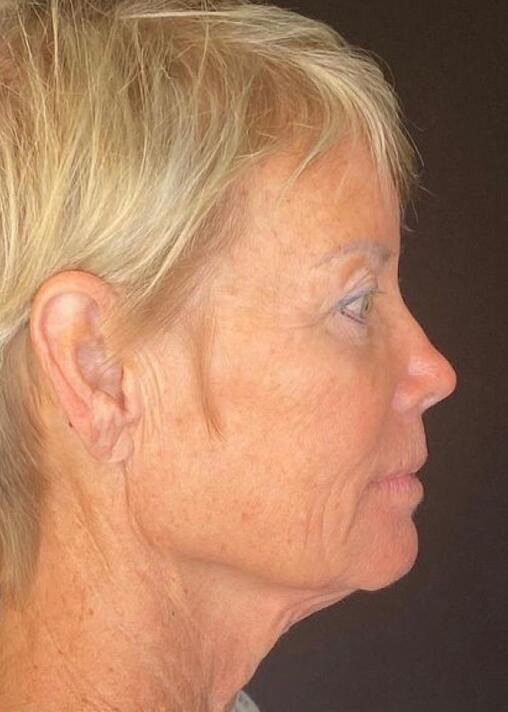 Deep Plane Facelift Before & After Image