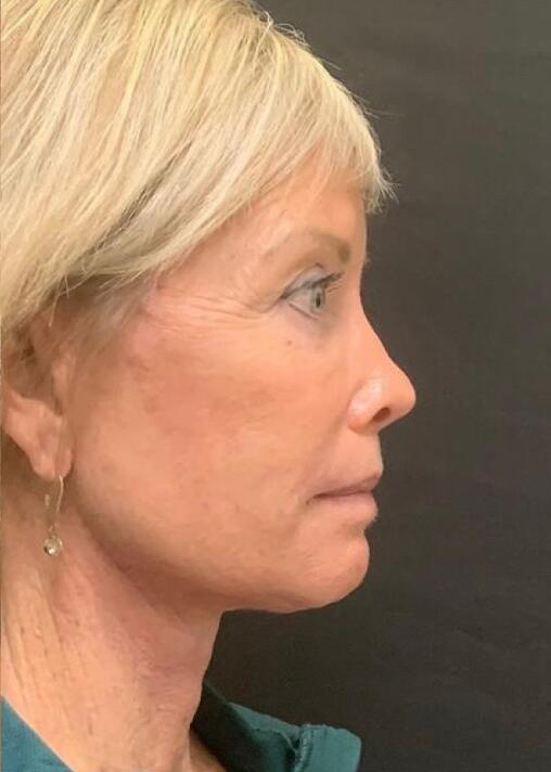 Deep Plane Facelift Before & After Image