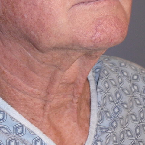 Direct Neck Lift Before & After Image