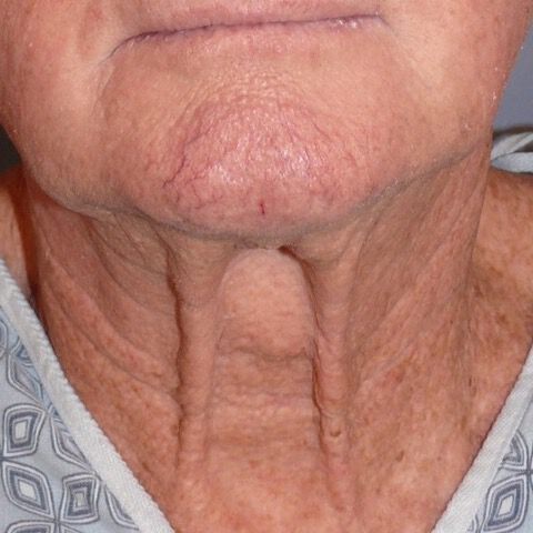 Direct Neck Lift Before & After Image