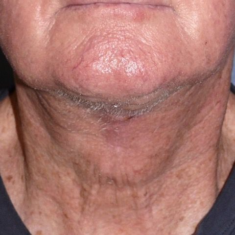 Direct Neck Lift Before & After Image