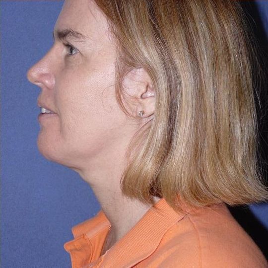 Direct Neck Lift Before & After Image