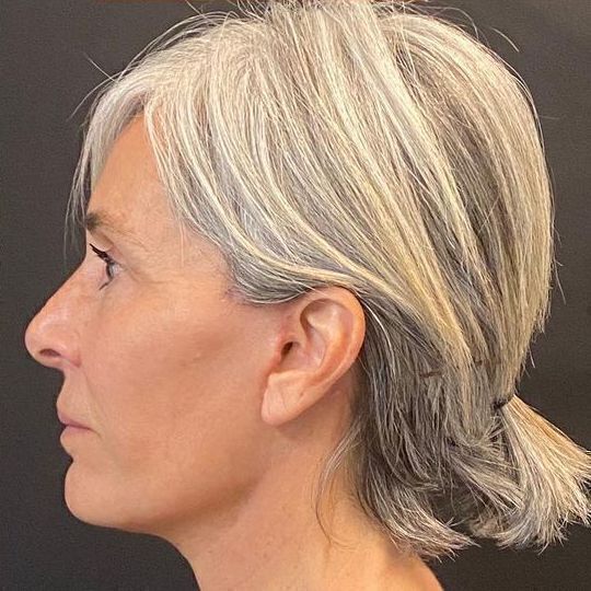 Direct Neck Lift Before & After Image