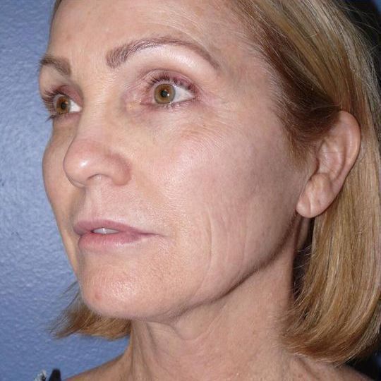 Direct Neck Lift Before & After Image