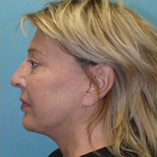 Direct Neck Lift Before & After Image