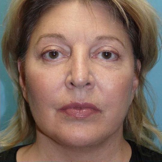 Facelift Before & After Image