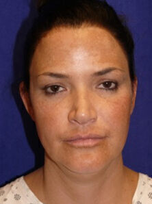 Facelift Before & After Image