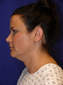 Facelift Before & After Image