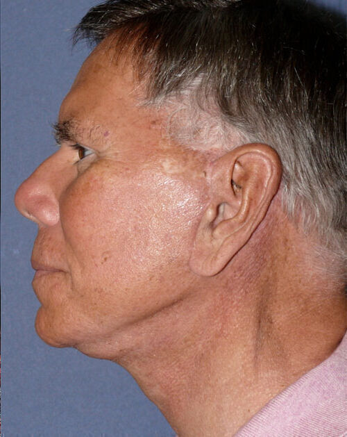 Facelift Before & After Image