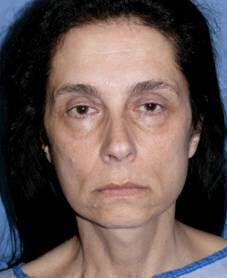 Facelift Before & After Image