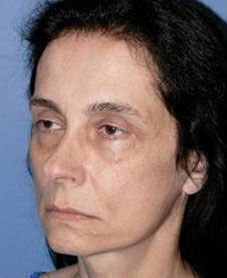 Facelift Before & After Image