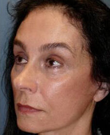 Facelift Before & After Image