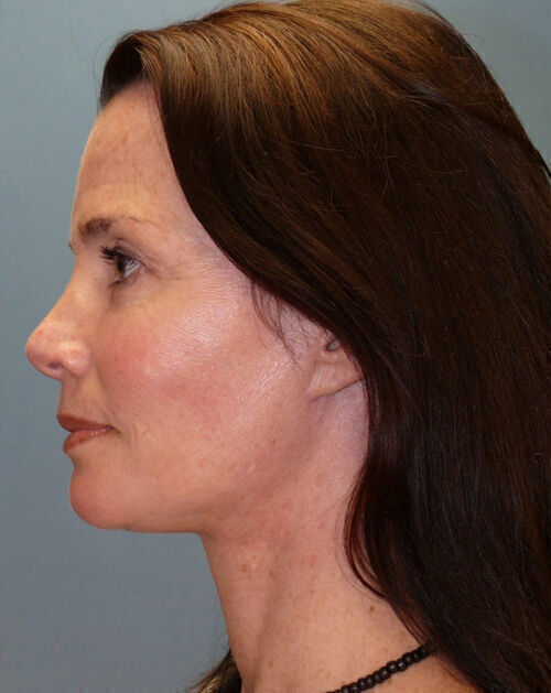 Facelift Before & After Image