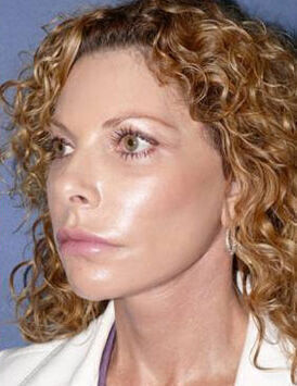 Facelift Before & After Image