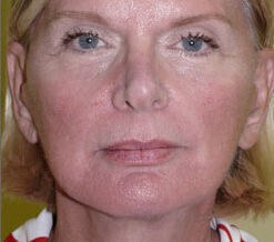 Facelift Before & After Image