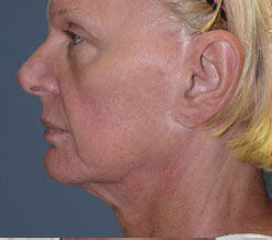 Facelift Before & After Image