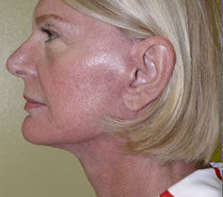 Facelift Before & After Image