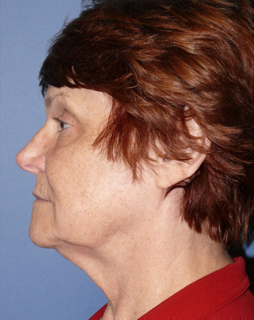 Facelift Before & After Image