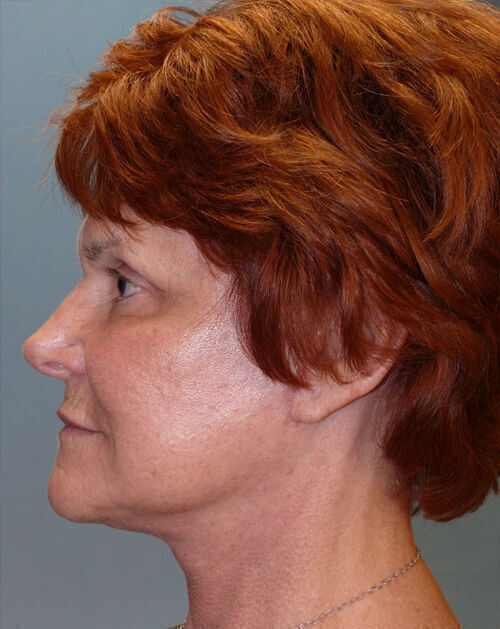 Facelift Before & After Image