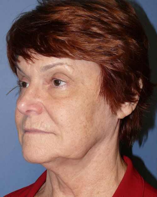 Facelift Before & After Image