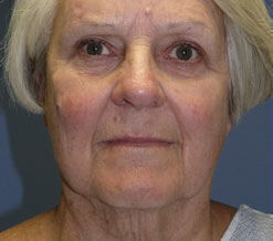 Facelift Before & After Image