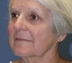 Facelift Before & After Image