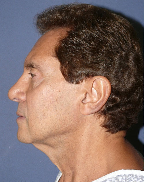 Facelift Before & After Image