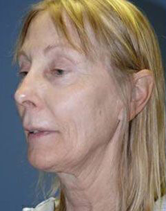 Facelift Before & After Image