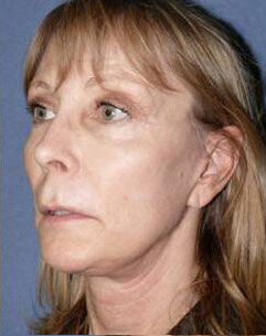 Facelift Before & After Image