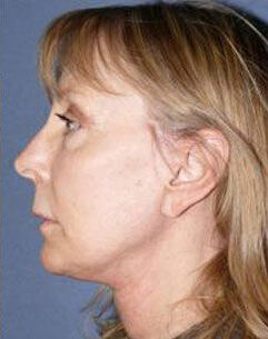 Facelift Before & After Image