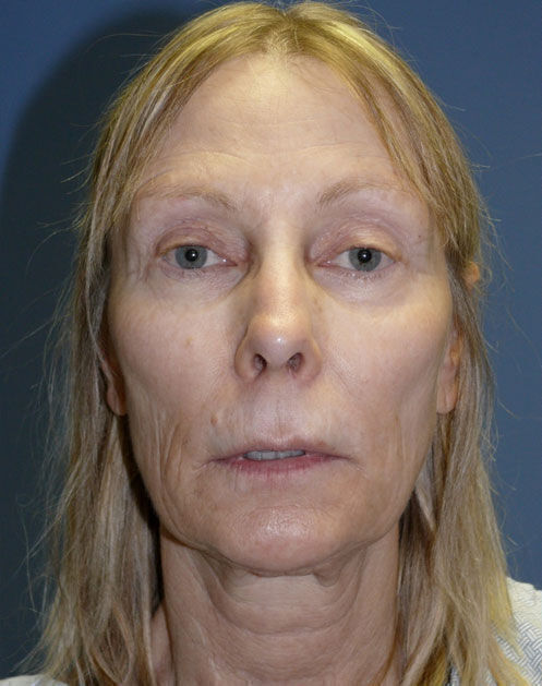 Facelift Before & After Image