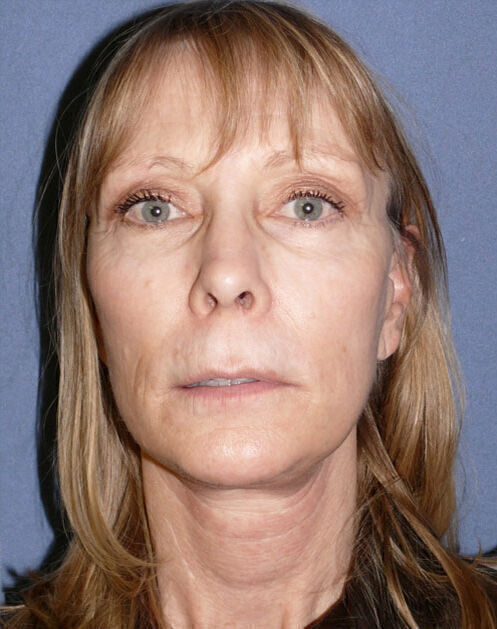 Facelift Before & After Image