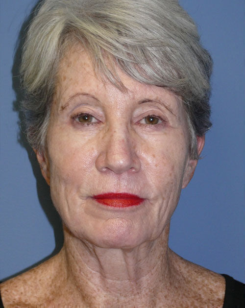 Facelift Before & After Image