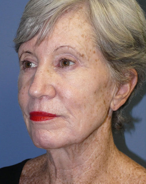 Facelift Before & After Image