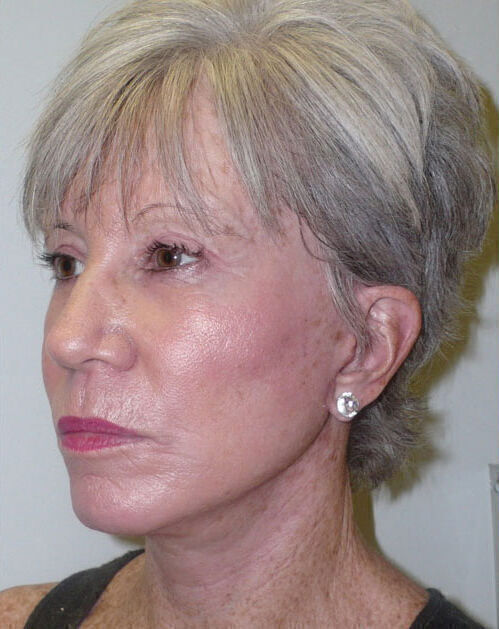 Facelift Before & After Image