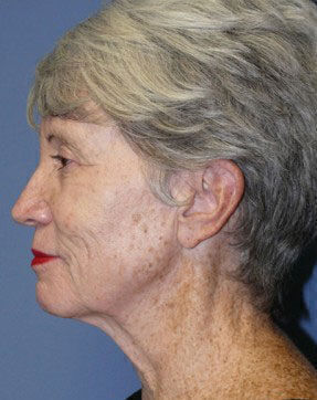 Facelift Before & After Image