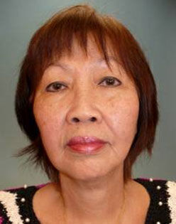 Facelift Before & After Image