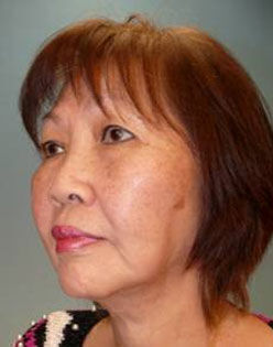 Facelift Before & After Image