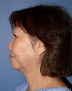 Facelift Before & After Image